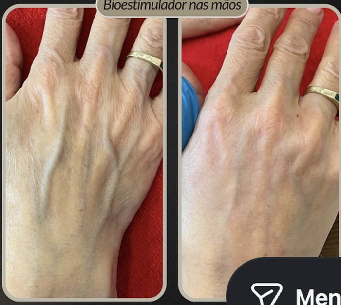 Rejuvenescimento das Mãos na BeautCorps