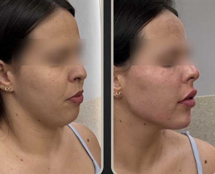 Perfiloplastia na BeautCorps