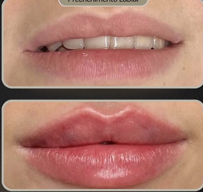 Preenchimento Labial na BeautCorps