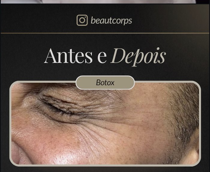 Queda Capilar na BeautCorps